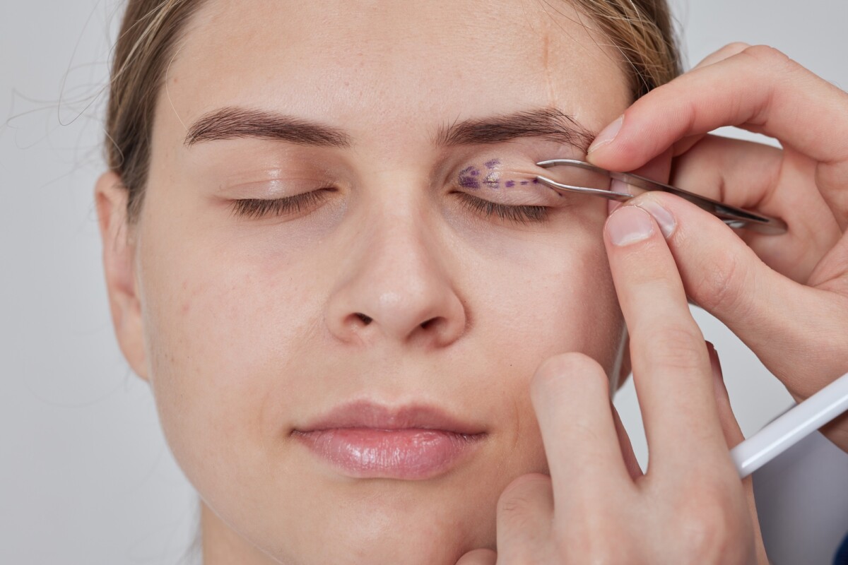 Does Medicare Pay For Blepharoplasty Key Coverage